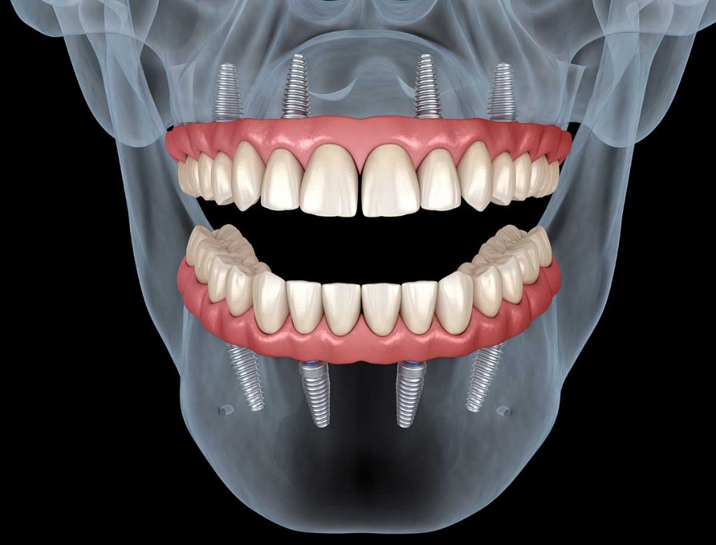 Full arch dental implant front view