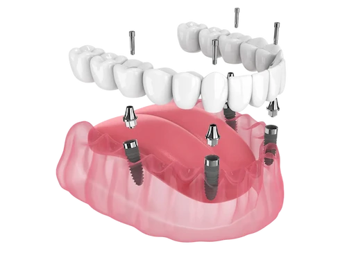 All-on-4 dental implants in Los Algodones Mexico