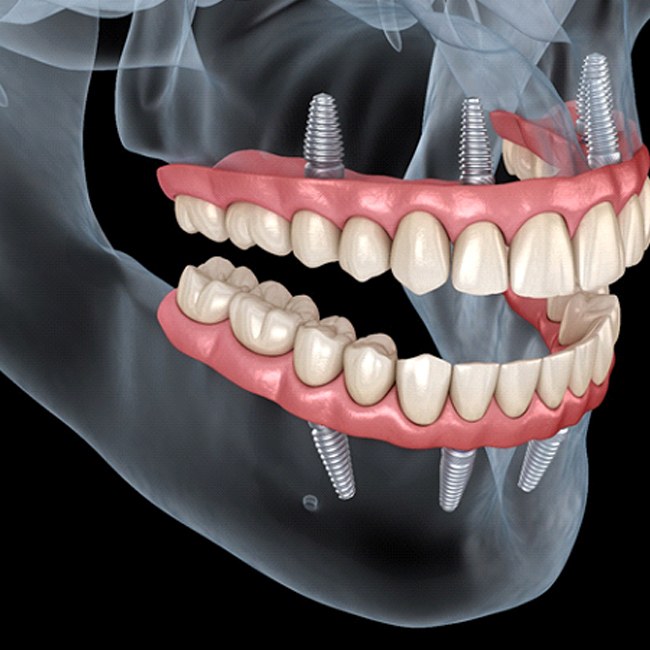 Zirconia dental implant bridge angular view