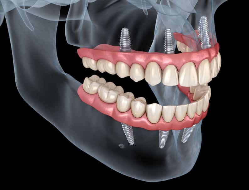 Full arch dental implant restoration side view