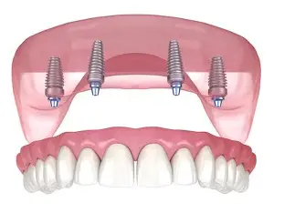 Full upper jaw dental implants