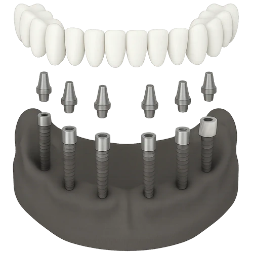 All-on-6 Dental Implants in Mexico