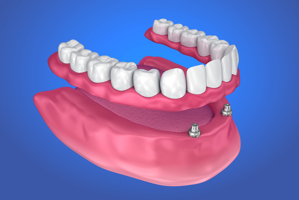 Implant supported snap on dentures Mexico