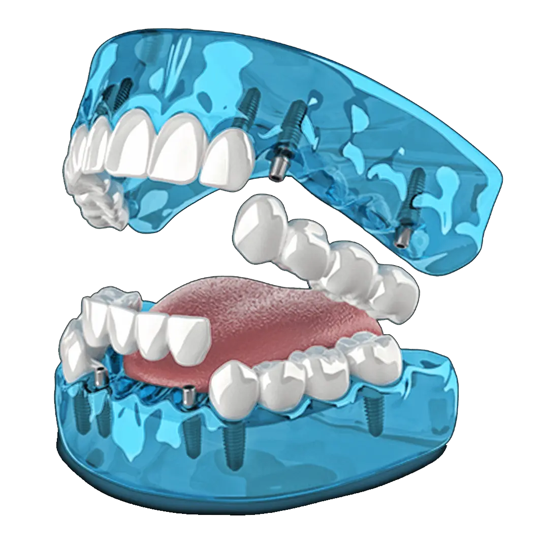 Patented 3-ON-8 dental implant protocol by Dr. Moguel
